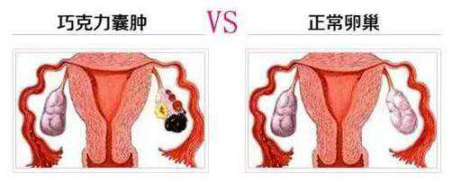巧克力囊肿患者可以做美国试管婴儿吗？