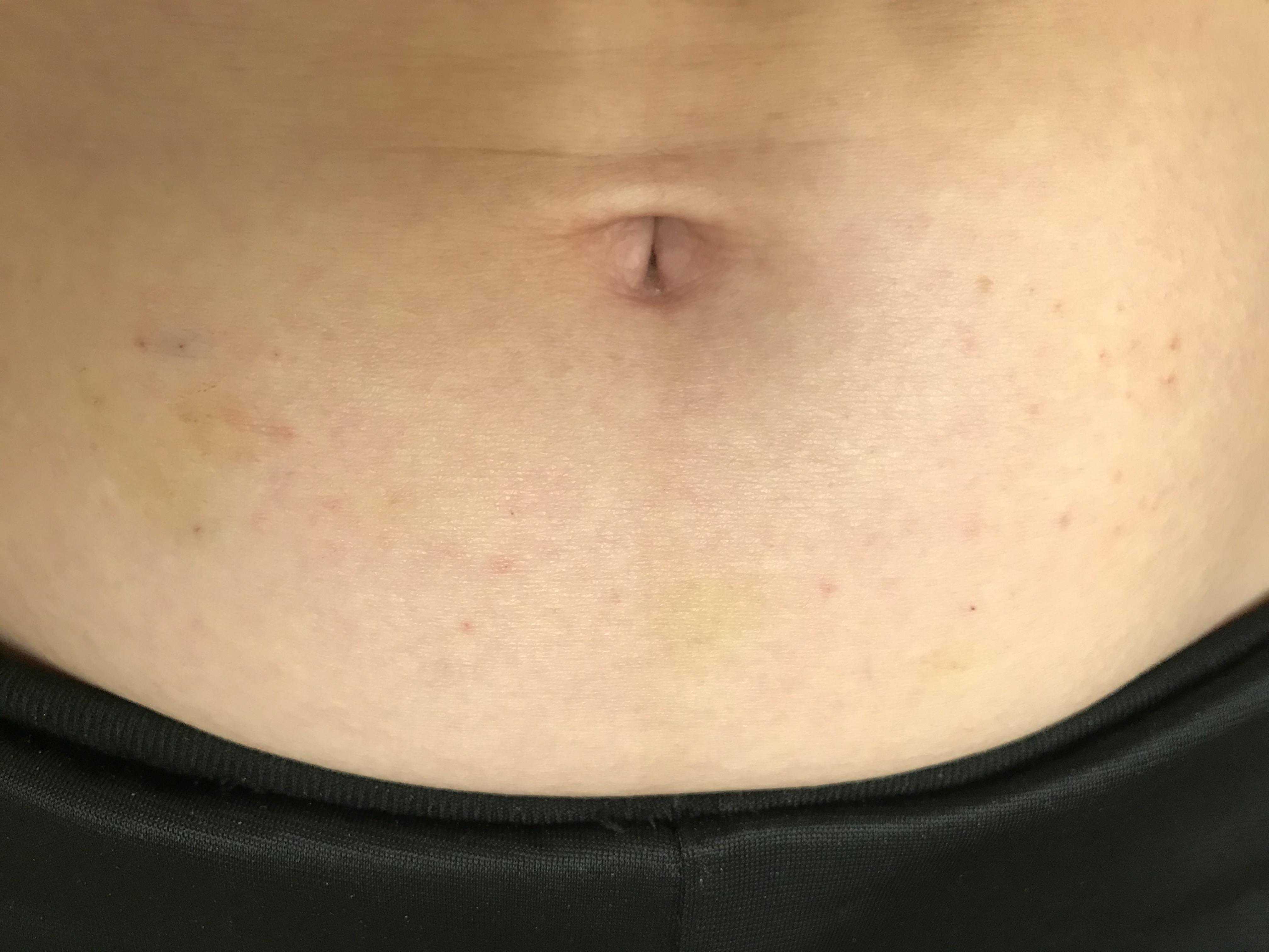 在美国试管取卵后的那些事儿