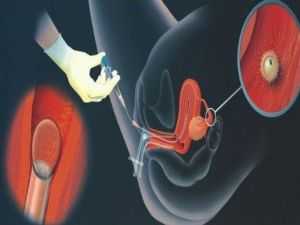 人工授精和试管婴儿都属人工受孕，两者有何不同？开始时不一样