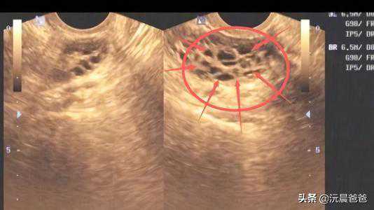 多囊卵巢备孕七年，促排八次，人授三次，试管三次，从没想过放弃