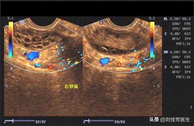 多囊女性做试管婴儿，不了解这些注意事项，就别轻易下决定