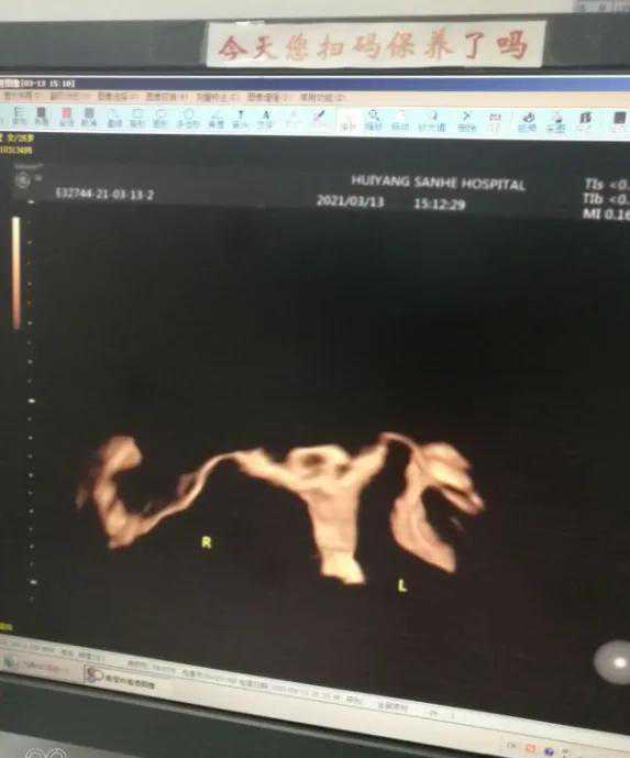 30岁女士备孕多年仍无果，这个检查“揪出”原因？